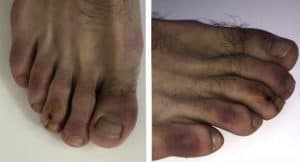أعراض جديدة في أصابع الأقدام قد تكون من علامات الإصابة بفيروس كورونا