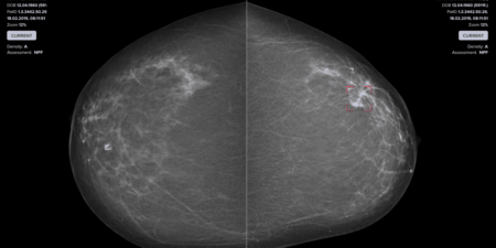 الذكاء الاصطناعي يساعد الأطباء في تشخيص أكثر دقة لسرطان الثدي