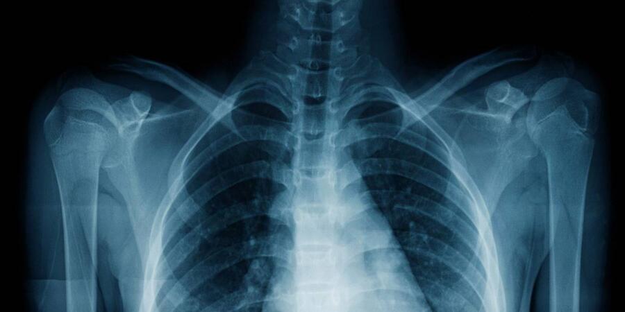نظام ذكاء اصطناعي يعتمد على الملاحظات الطبية لتعليم نفسه كيفية كشف الأمراض في صور الأشعة السينية للصدر